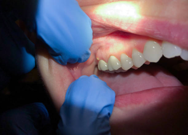 Best Emergency Gum Treatment in Shepherd, MI